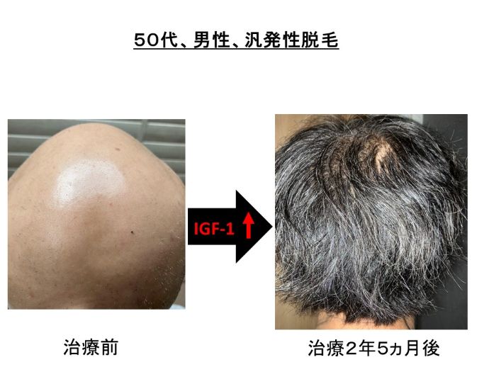 円形脱毛症　病院